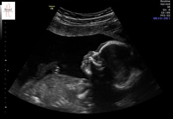 2D ultrasound profile