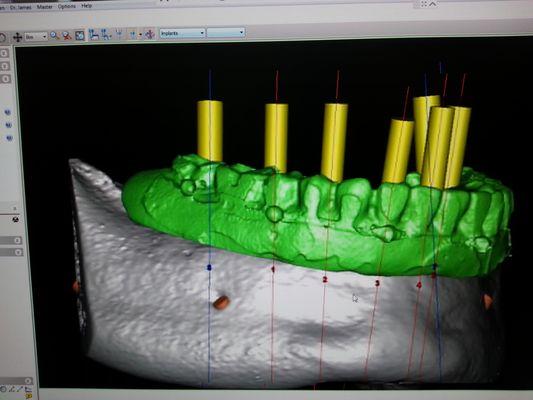 Our 3D cone beam scanner helps us visualize where anatomic structures in relation to where the teeth will be set in the prosthesis.