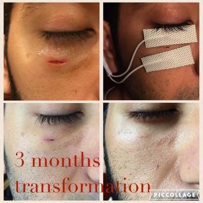 Half inch cut, no stitches and 10 min of microcurrent for 2 weeks with recommended products and now scar is hardly there