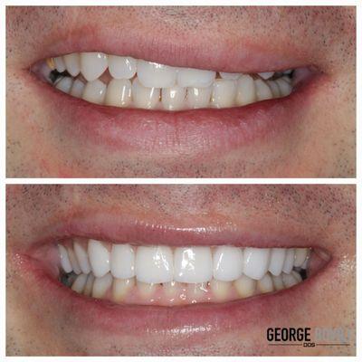 Smile rejuvenation with upper porcelain veneers