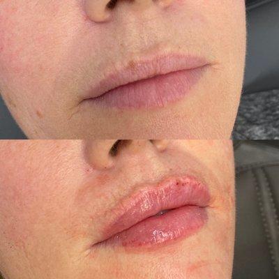 Before and After Lip Filler