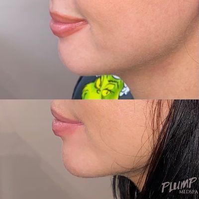 Chin augmentation