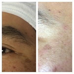 Results after microdermabrasion and micro-current targeted treatment.