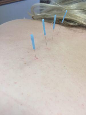 Acupuncture: a great form of treatment for pain, headaches, anxiety, infertility, & depression. The list could go on and on!