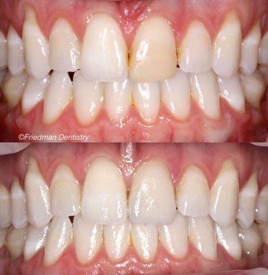 Dr. Matt provided this patient with a single central incisor veneer to replace old discolored bonding.