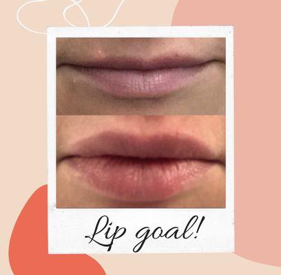 Lip filler ( JUVÉDERM® Volbella 2 cc)