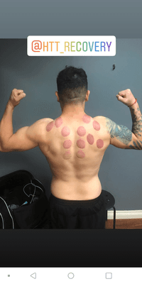 Cupping