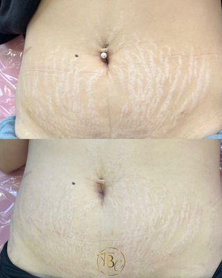 Inkless Stretch Mark Rejuvenation - After 1 Session