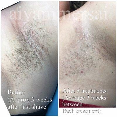 Epilfree is a non-laser permanent hair reduction option!