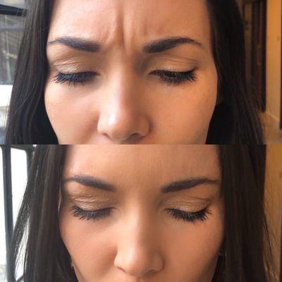 Before and after of Botox to the brow