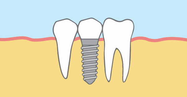 Dental Implant