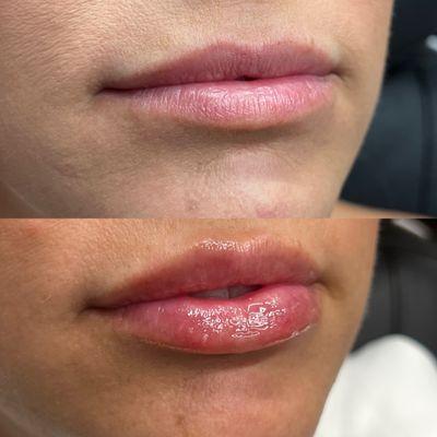 1 ml Juvederm Ultra to lips