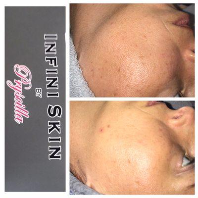 Spot Removal & Microneedling & Skin Tightening