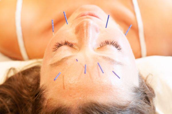 facial and cosmetic acupuncture is just one of the services we use to help naturally rejuvenate skin