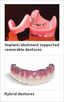 Overdenture with a bar vs. All on 6 or more