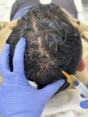 PRP Hair loss