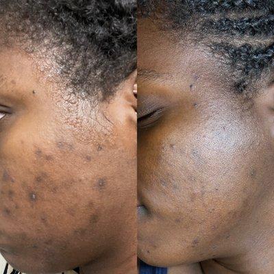 2 VI Peels and 2 microdermabrasion Treatments