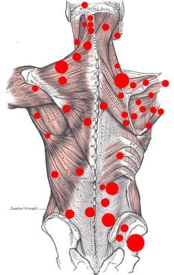 Trigger Point Dry Needling. Experienced, precise and through.