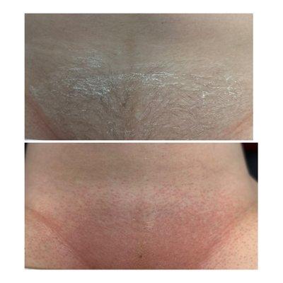 Before & After Brazilian Wax.  Redness goes away after treatment.