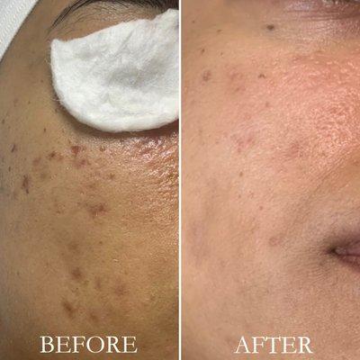 Microneedling