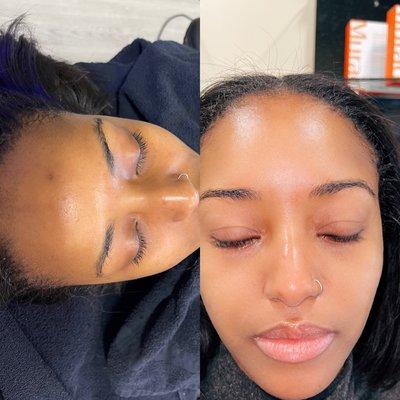 Before and after photos of deluxe HydraFacial