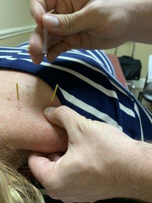 Dry Needling