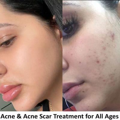 Acne Facial Treatment For All Ages