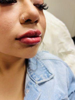 Lip enhancement