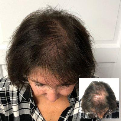 Density Fill Scalp Micropigmentation - Hair Loss Solution