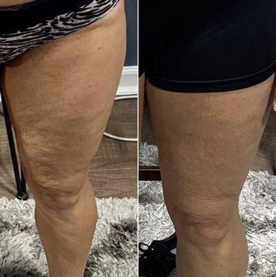 Before and after real results from using UltraSlim technology for fat loss and skin tightening