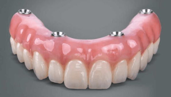 All-on-four implant denture