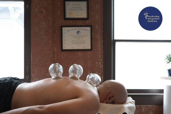 A combination of acupuncture and cupping therapy in the treatment of sports medicine performed by Dr. Alejandra Reyes, DACM, L.Ac.