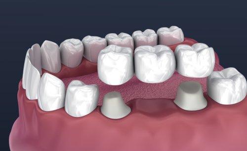 A dental bridge offers teeth replacement for one or more adjacent teeth. The bridge is made of a dental crown on each end wit...