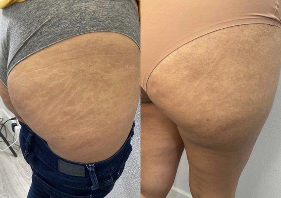 Brazilian Inkless stretch mark removal