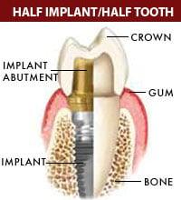 dental implant