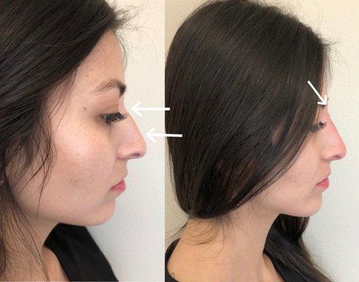 Non-Surgical Nose Job