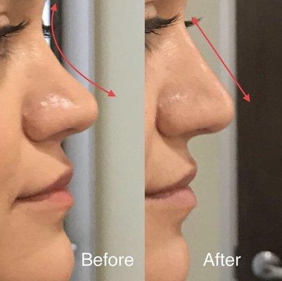 Non- surgical nose job