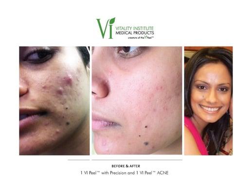 VI Peel on Acne.