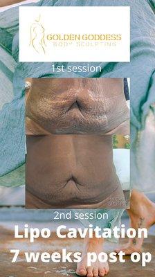 After surgery sometimes there's still more fat lipo cavitation can get rid of unwanted fat