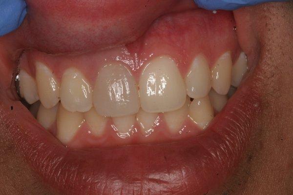 Conservative treatment for a discolored tooth.  Before photo.