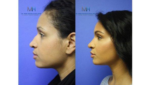 Rhinoplasty Before and After