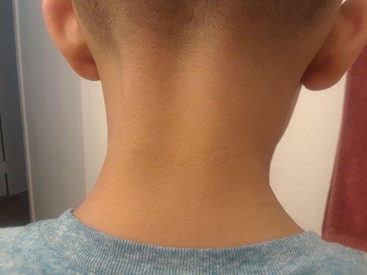 Small cuts all over the back of his neck.