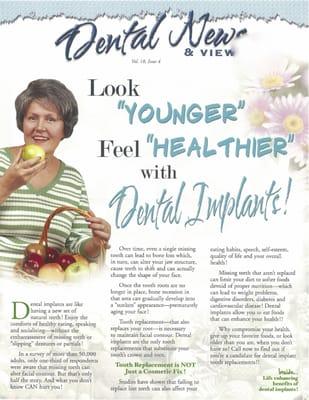 Look younger with Dental Implants