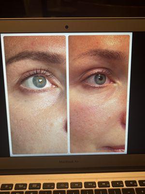 Before and after eyes micro massage