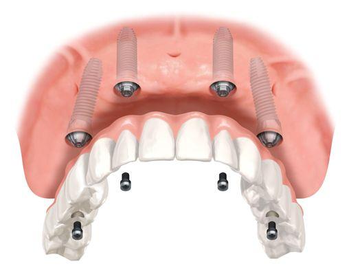 Implant Denture