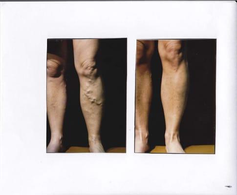 Varicose veins by single session ambulatory phlebectomy before and after picture 6 weeks apart.