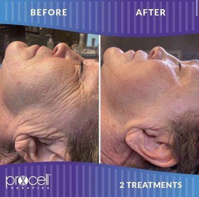 ProCell Treatments