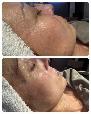 Before facial, large pores and deep lines; after facial, glowing and smooth.