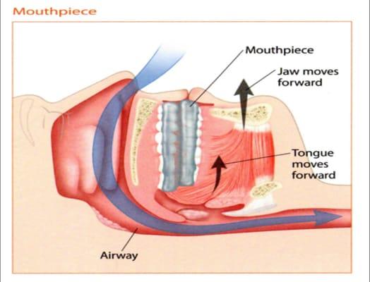 By protruding the mandible (lower jaw) forward, the obstructed airway is naturally held open without the need for CPAP masks,...