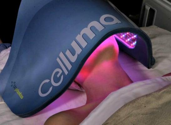 Celluma LED Light Therapy For Acne & Anti-aging